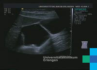 Normal Gallbladder – Atlas of Ultrasound