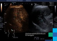 Diffuse growing HCC infiltrating the portal vein (series of images ...
