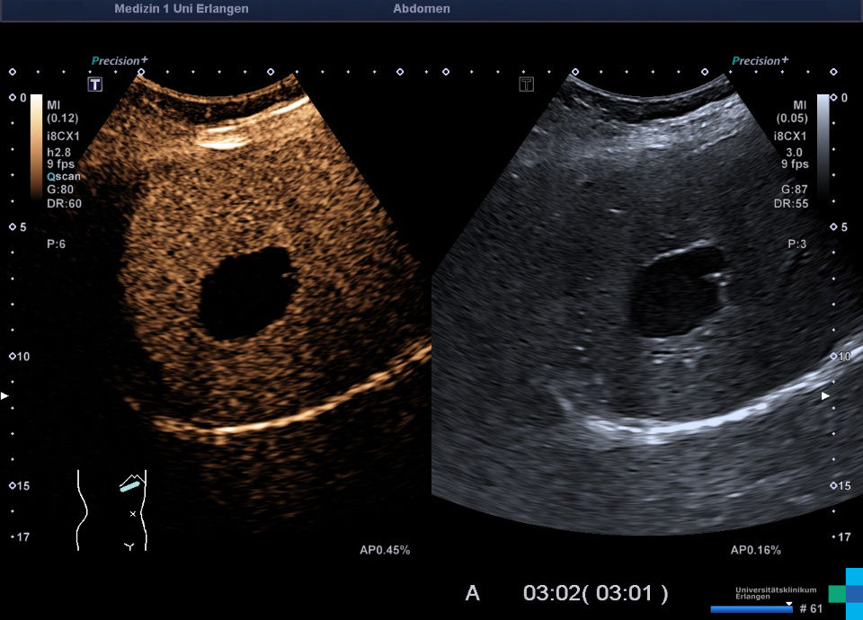 Complex Liver Cyst Ultrasound