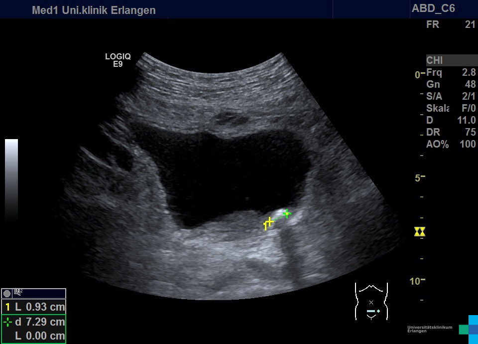 Hypogastric region – Atlas of Ultrasound