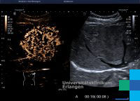 Inflammatorisches Adenom (Bilder-/Videoserie) – Sonographieatlas Erlangen