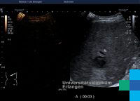 Leberabszess Sonographieatlas Erlangen