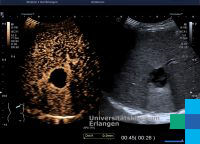 Leberabszess Sonographieatlas Erlangen