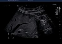 Gallbladder polyps – Atlas of Ultrasound