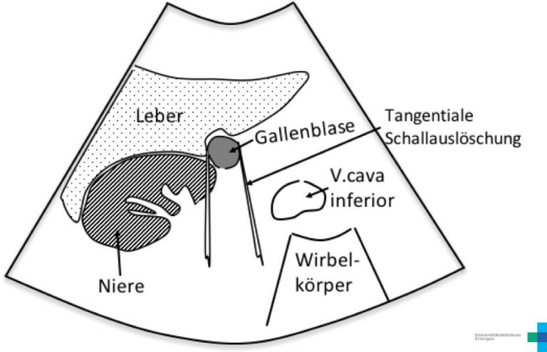 Normalbefunde Gallenblase Sonographieatlas Erlangen normalbefunde-gallenblase-sonographieatlas-erlangen
