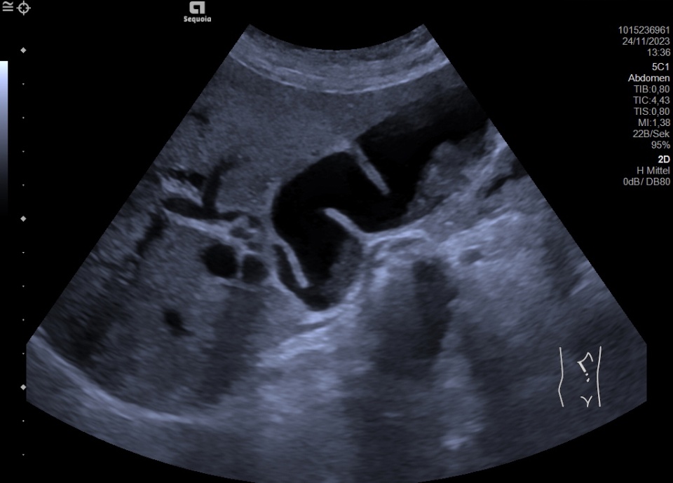 Cholestasis Atlas of Ultrasound