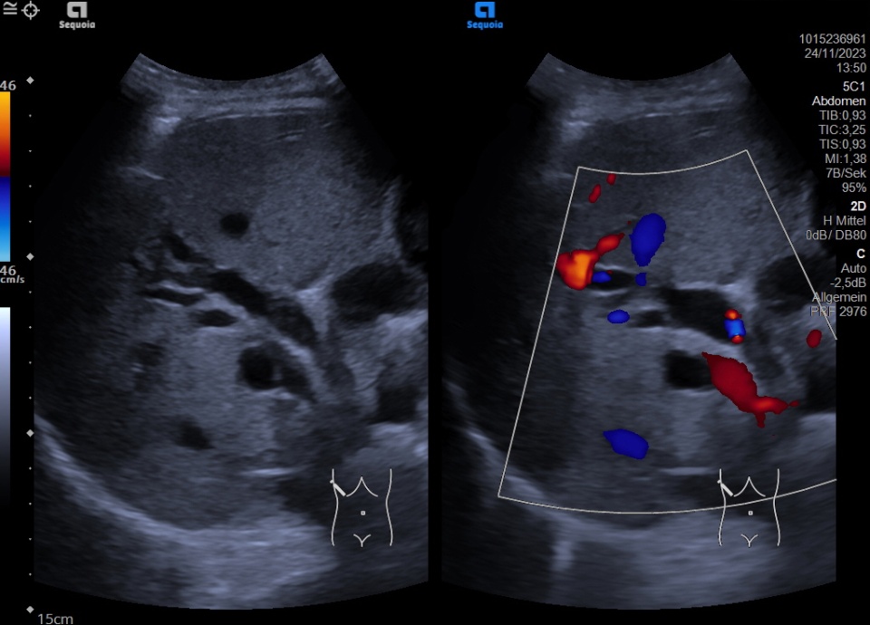 Cholestasis Atlas of Ultrasound